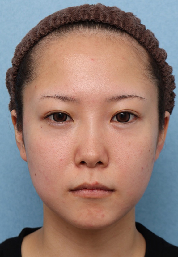【症例写真】ウルセラと顔の脂肪溶解注射のコンビネーションで2ヶ月で頬がホッソリした症例：美容外科 高須クリニック
