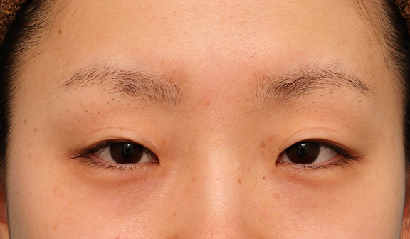 眼瞼下垂（がんけんかすい）,患者様の希望で幅広平行型二重を眼瞼下垂手術で作り、同時に目頭切開と目尻切開を行った症例写真,Before,ba_ganken039_b01.jpg