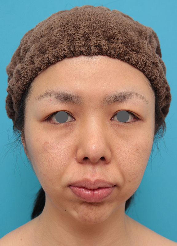 鼻尖形成（鼻尖縮小・だんご鼻修正）,鼻尖形成、耳介軟骨移植、顎プロテーゼ入れの症例写真,After（1年半後）,ba_bisen029_b01.jpg