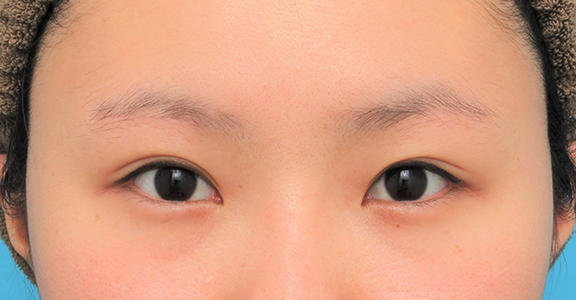 眉下リフト（上眼瞼リフト）,眉下リフト（上眼瞼リフト）を行った20代女性の症例写真,After（6ヶ月後）,ba_jougankenlift011_a01.jpg