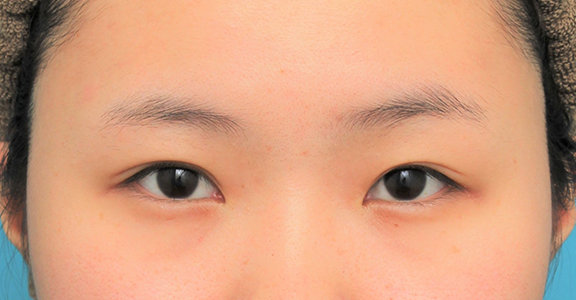 眉下リフト（上眼瞼リフト）,眉下リフト（上眼瞼リフト）を行った20代女性の症例写真,Before,ba_jougankenlift011_b01.jpg