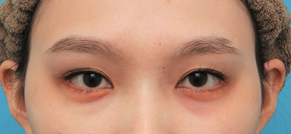 目尻切開,目尻切開＋垂れ目形成（グラマラスライン）を行った20代女性の症例写真,After（6ヶ月後）,ba_mejiri023_b01.jpg