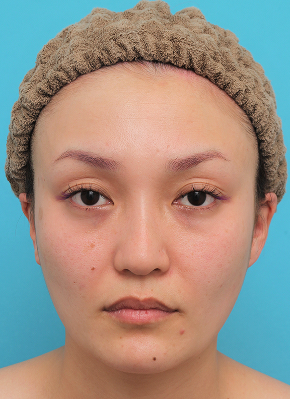頬骨切り／削り,頬骨削り＋エラボツリヌストキシン注射で輪郭を整えた30代女性の症例画像,After（4ヶ月後）,ba_hohobone001_b01.jpg