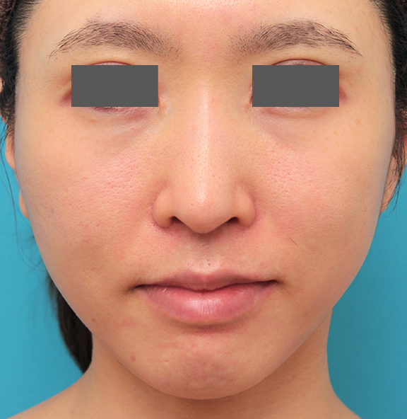 鼻翼縮小（小鼻縮小）,鼻の下を短く（上口唇短縮手術、上口唇リフト、リップリフト、人中短縮術）,小鼻縮小と人中短縮を同時に行った30代女性の症例写真,After（6ヶ月後）,ba_biyoku053_a01.jpg