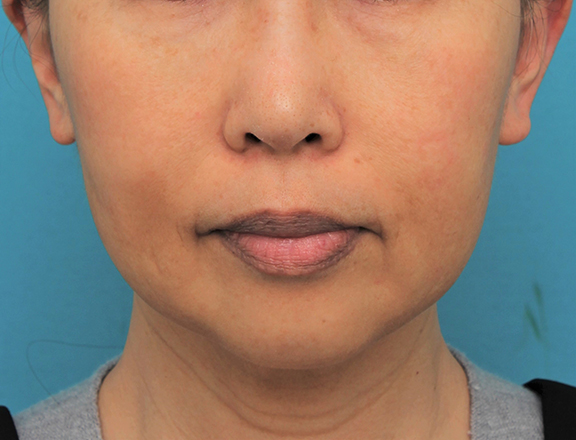 顎にシリコンプロテーゼを入れた50代後半女性の症例写真,Before,ba_ago024_b01.jpg