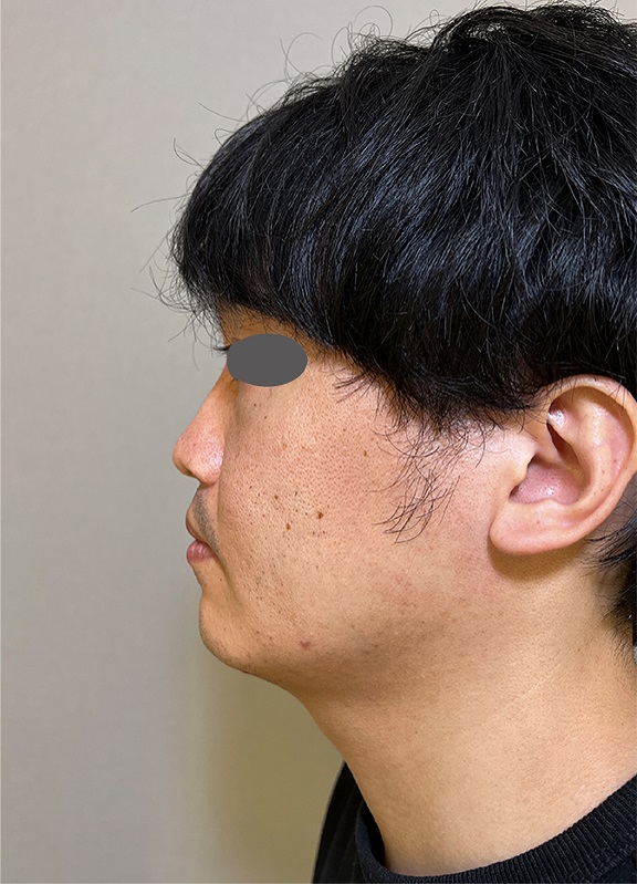 耳介軟骨移植で鼻先を高くスマートに整えた症例写真,Before,ba_jikai048_b01.jpg
