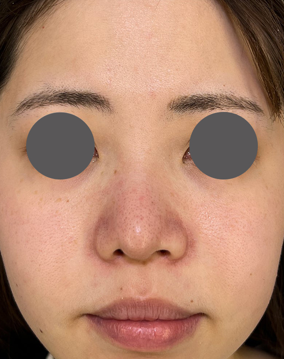 鼻尖形成（鼻尖縮小・だんご鼻修正）,鼻尖形成、小鼻縮小、耳介軟骨移植を行った症例写真,After（4ヶ月後）,ba_bisen031_b01.jpg
