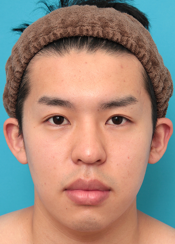 眼瞼下垂（がんけんかすい）,眼瞼下垂手術で目を大きくして二重を作った20代男性の症例写真,After（6ヶ月後）,ba_ganken047_a01.jpg