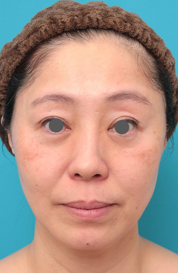 症例写真,ミディアムフェイスリフトを行った50代女性症例写真,After（6ヶ月後）,ba_mediumlift024_b01.jpg