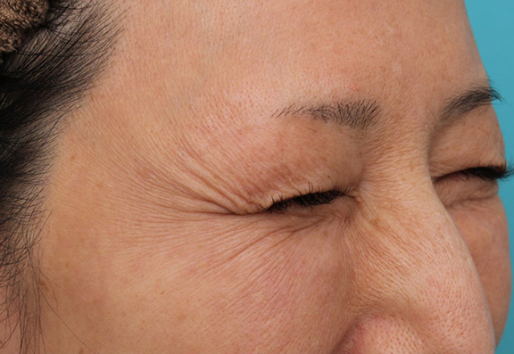 症例写真,きめ細かいお肌へ導くツヤ肌注射の症例写真,Before,ba_tsuyahada002_b02.jpg
