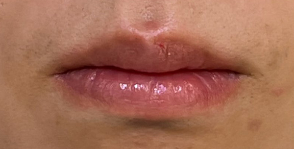 症例写真,口唇縮小術で唇を薄くした症例写真,After（1ヶ月後）,ba_usuku024_b01.jpg