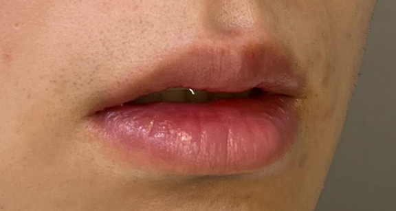 症例写真,口唇縮小術で唇を薄くした症例写真,After（1ヶ月後）,ba_usuku024_b02.jpg