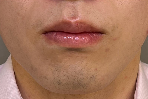 症例写真,口唇縮小術で唇を薄くした症例写真,After（1ヶ月後）,ba_usuku024_b03.jpg