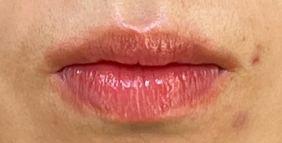 症例写真,口唇縮小術で唇を薄くした症例写真,Before,ba_usuku024_b01.jpg