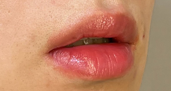 症例写真,口唇縮小術で唇を薄くした症例写真,Before,ba_usuku024_b02.jpg