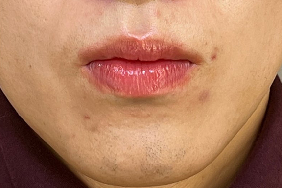 症例写真,口唇縮小術で唇を薄くした症例写真,Before,ba_usuku024_b03.jpg
