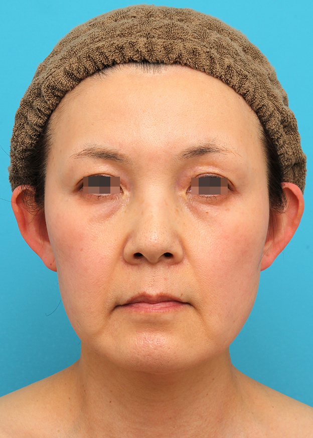 症例写真,ミニフェイスリフトを行った50代女性症例写真,手術前,mainpic_minilift19a.jpg