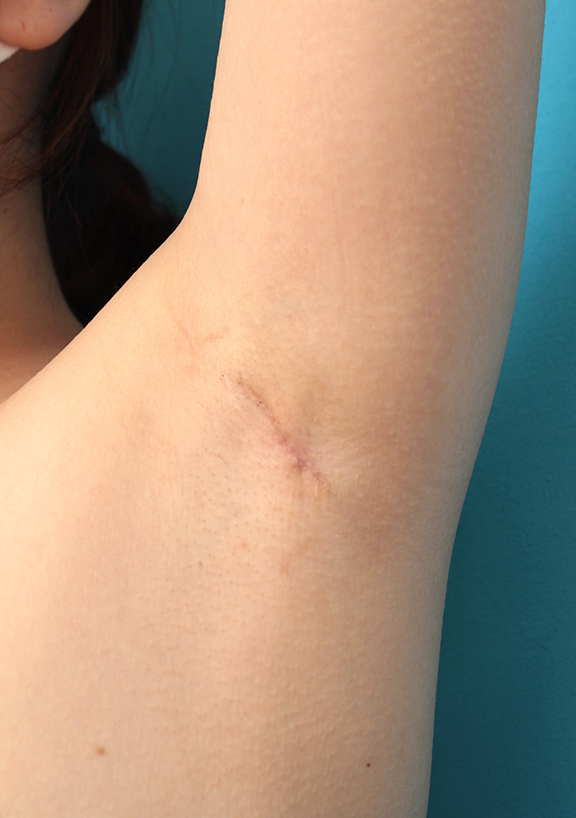 他院ワキガ手術後の傷跡修正手術の症例写真,After（7ヶ月後）,ba_keisei003_a.jpg