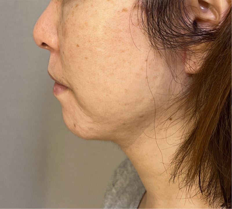 ミニフェイスリフトと脂肪吸引顎下でフェイスラインをすっきりさせた症例写真,After（3ヶ月後）,ba_minilift020_a01.jpg
