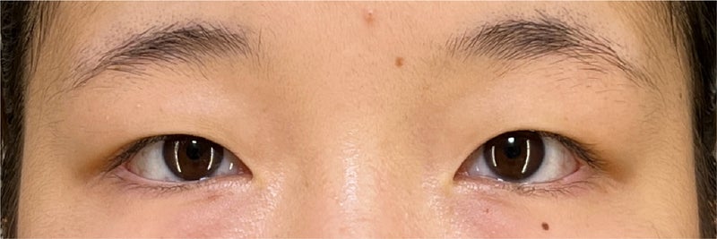 睫毛のキワが見えるような幅にした二重まぶた･埋没法の症例写真,Before,ba_maibotsu078_b01.jpg