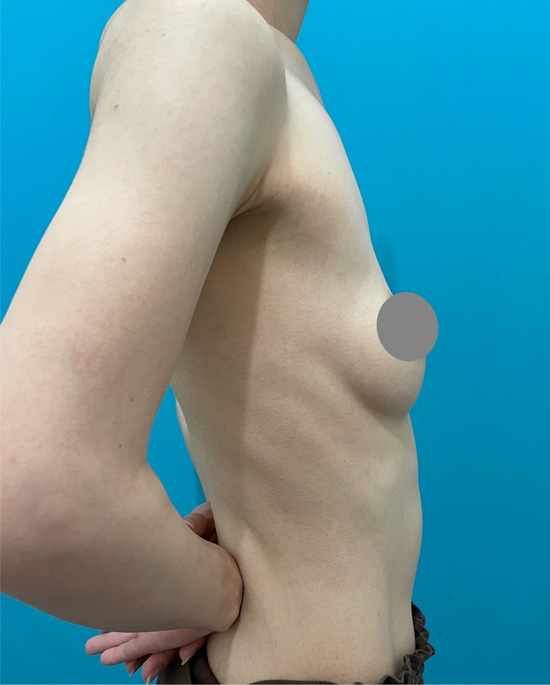 豊胸手術（シリコンプロテーゼ）で自然な釣鐘型の胸を作った症例写真,Before,ba_hokyo038_b01.jpg