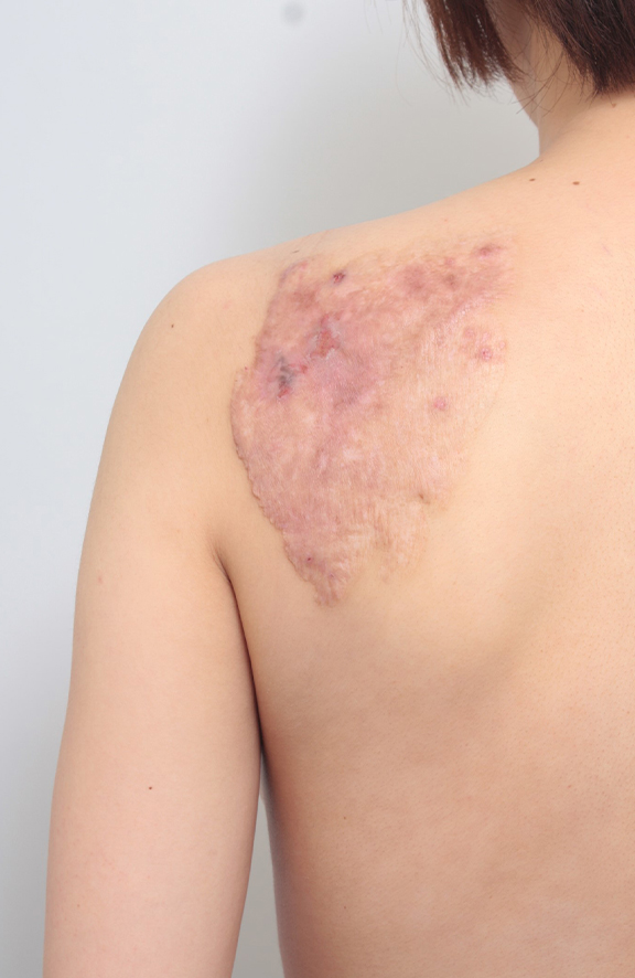 刺青（タトゥー）除去,肩の巨大な入れ墨を剝削手術で除去した20代女性の症例写真,After（1年後）,ba_irezumi039_a01.jpg