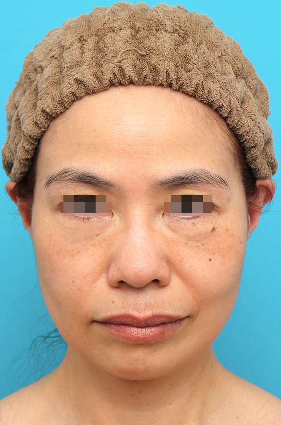 ミディアムフェイスリフト,ミディアムフェイスリフトを行った50代女性の症例写真,After（6ヶ月後）,ba_mediumlift025_a01.jpg