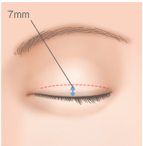 天然の一重まぶたと二重まぶたと奥二重の違い 埋没法や切開法で二重まぶたになる仕組みについて Dr 高須幹弥の美容整形講座 美容整形の高須クリニック